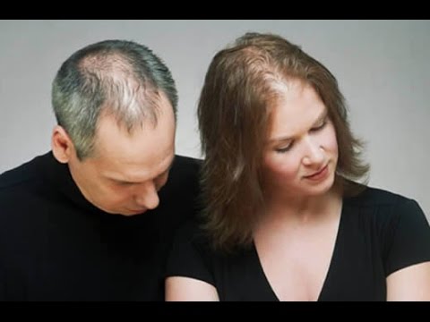 Treatment options for Baldness