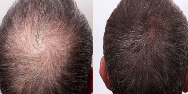 Treatment options for Baldness